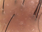  탈모진행형 두피