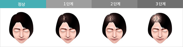 여성탈모의 유형