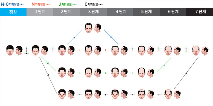 남성탈모의 유형