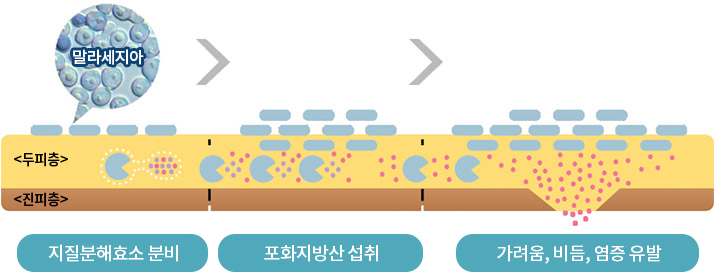 지질분해효소 → 분배 포화지방산 → 섭취, 가려움, 비듬, 염증유발